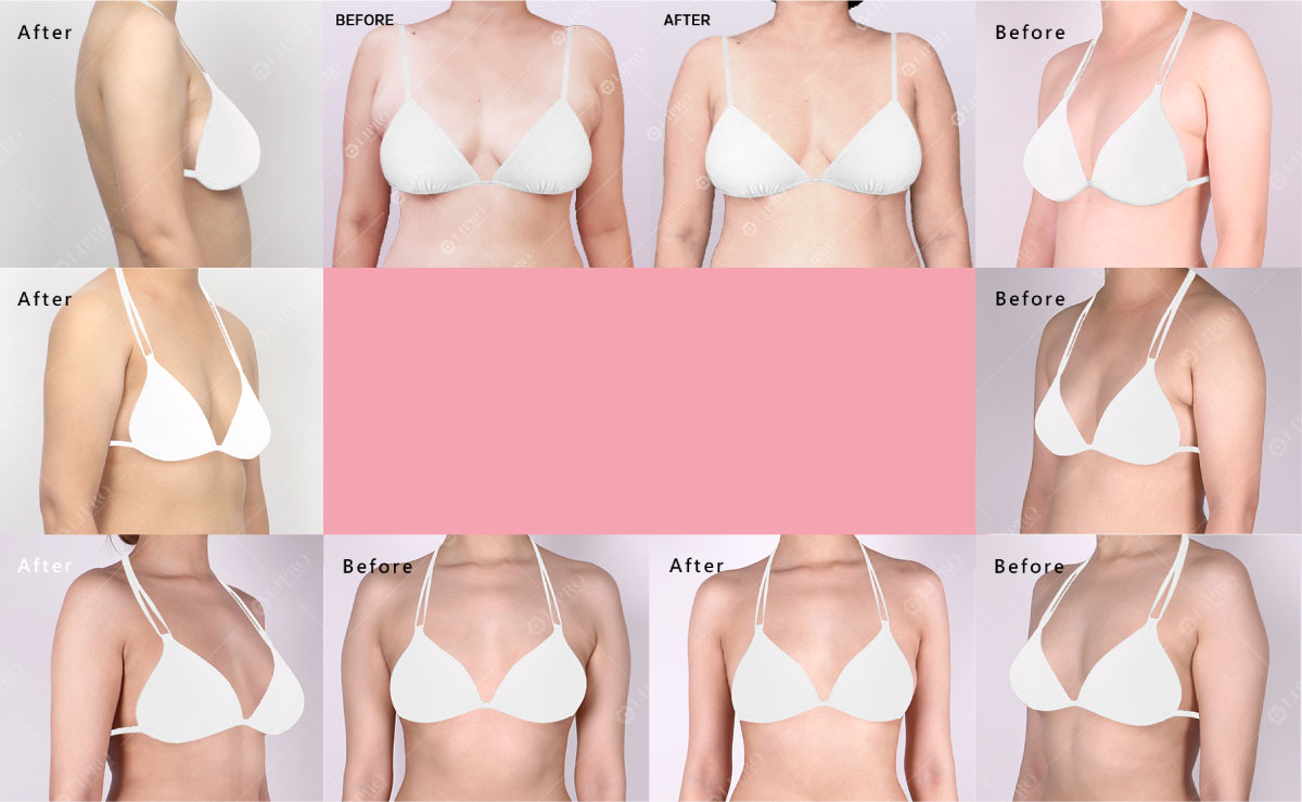 百人見證 顯微套管抽脂 滿足你的需求