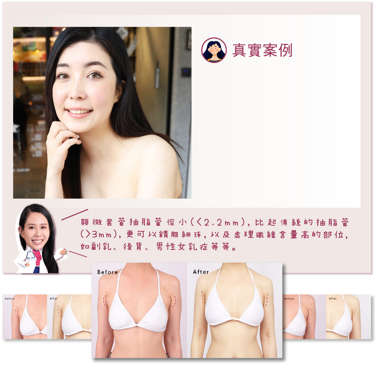 真實案例 顯微套管抽脂管徑小(<2.2mm),比起傳統的抽脂管(>3mm),更可以精雕細琢,以及處理纖維量高的部位,如副乳、後背、男性女乳症等等。