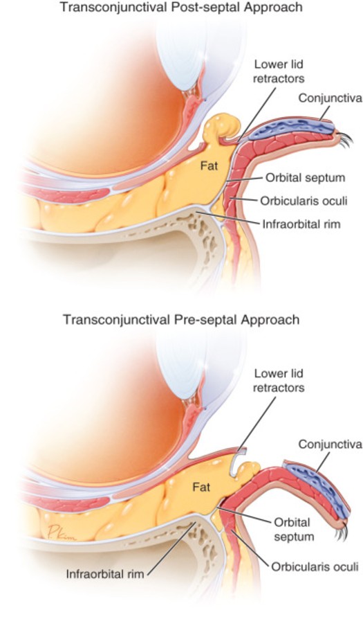 手術步驟1: 韌帶，肌肉，眼袋脂肪處理