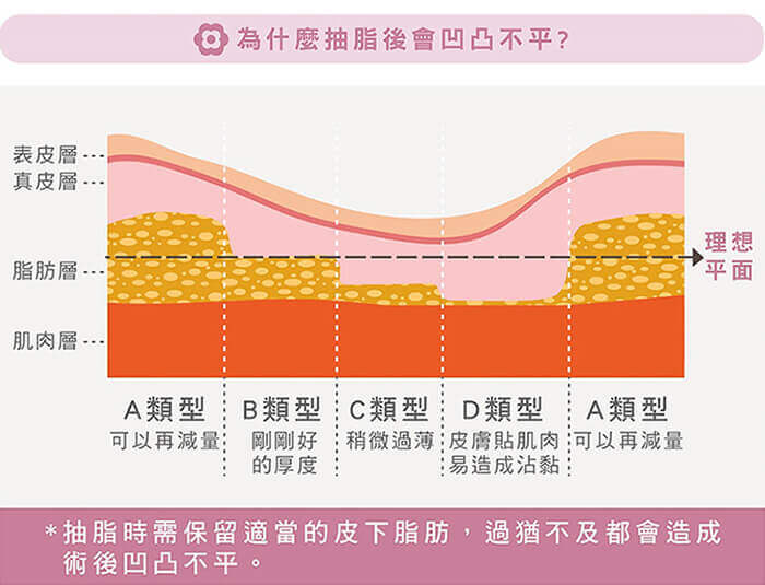 為什麼抽脂後會凹凸不平?圖表說明