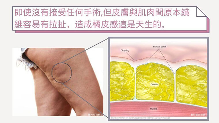 即使沒有接受任何手術，但皮膚與肌肉間原本纖維拉扯，造成橘皮是天生的