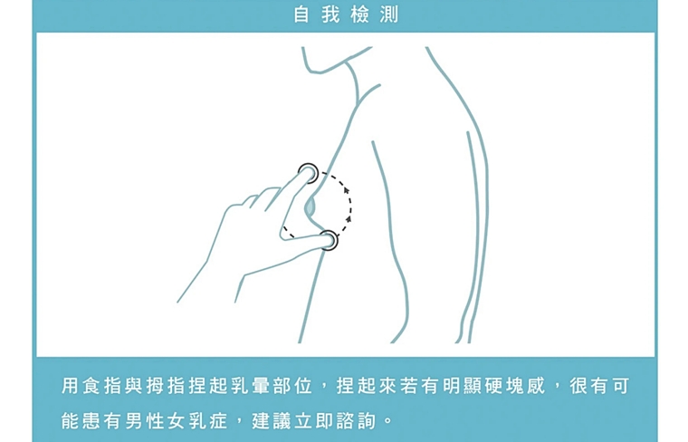 男性女乳症費用,男性女乳健保,女乳症費用,男性女乳保險理賠