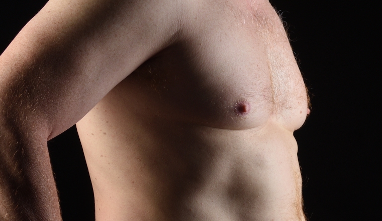 男性女乳症費用,男性女乳健保,女乳症費用,男性女乳保險理賠