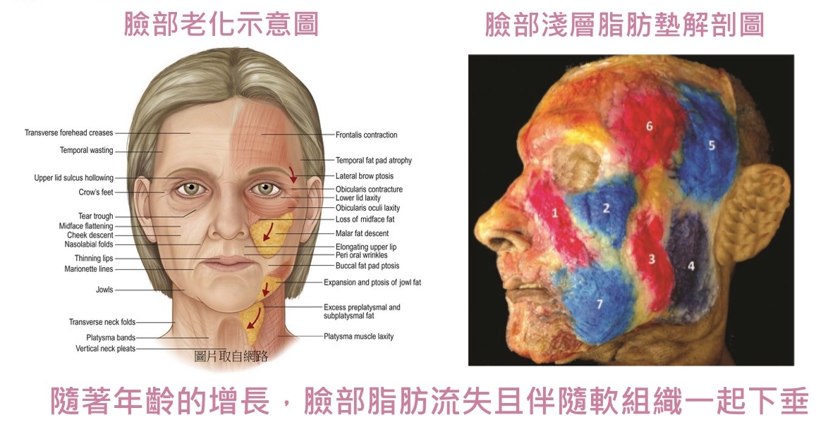 臉部老化示意圖&臉部淺層脂肪墊解剖圖